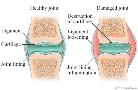 Stem cells for knee pain Virginia Beach consultation for knee arthritis and cartilage loss